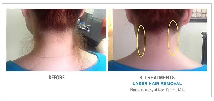 Neck Laser Hair Removal Before and After
